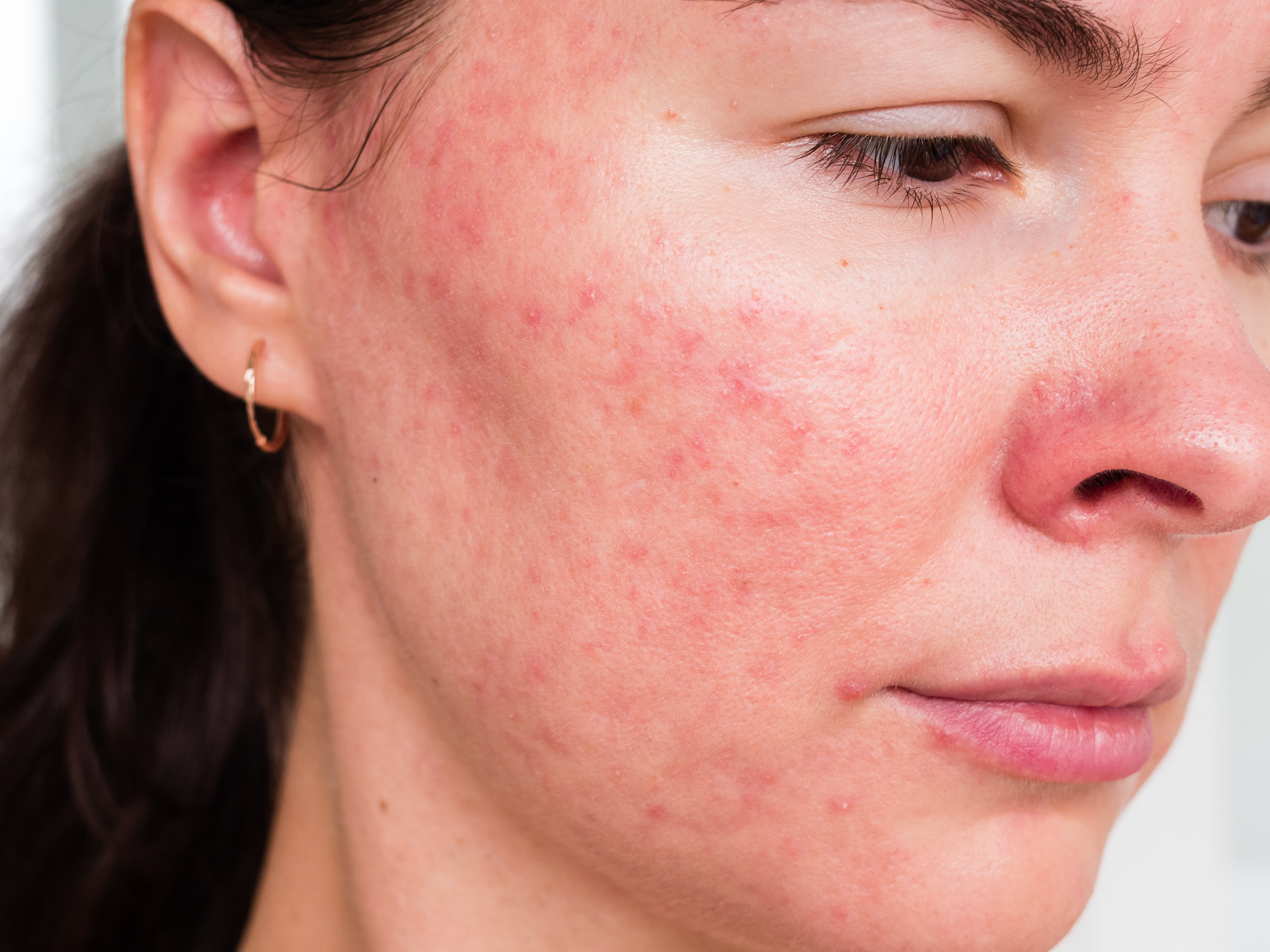 rosacea5