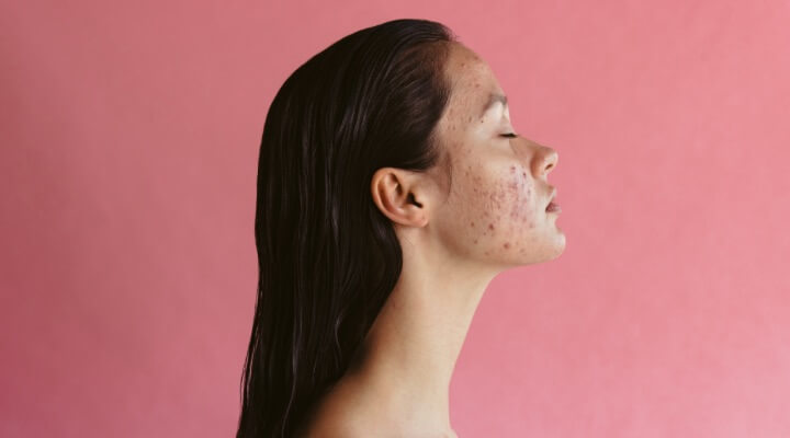 Side profile of woman with acne on her skin