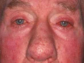 rosacea1